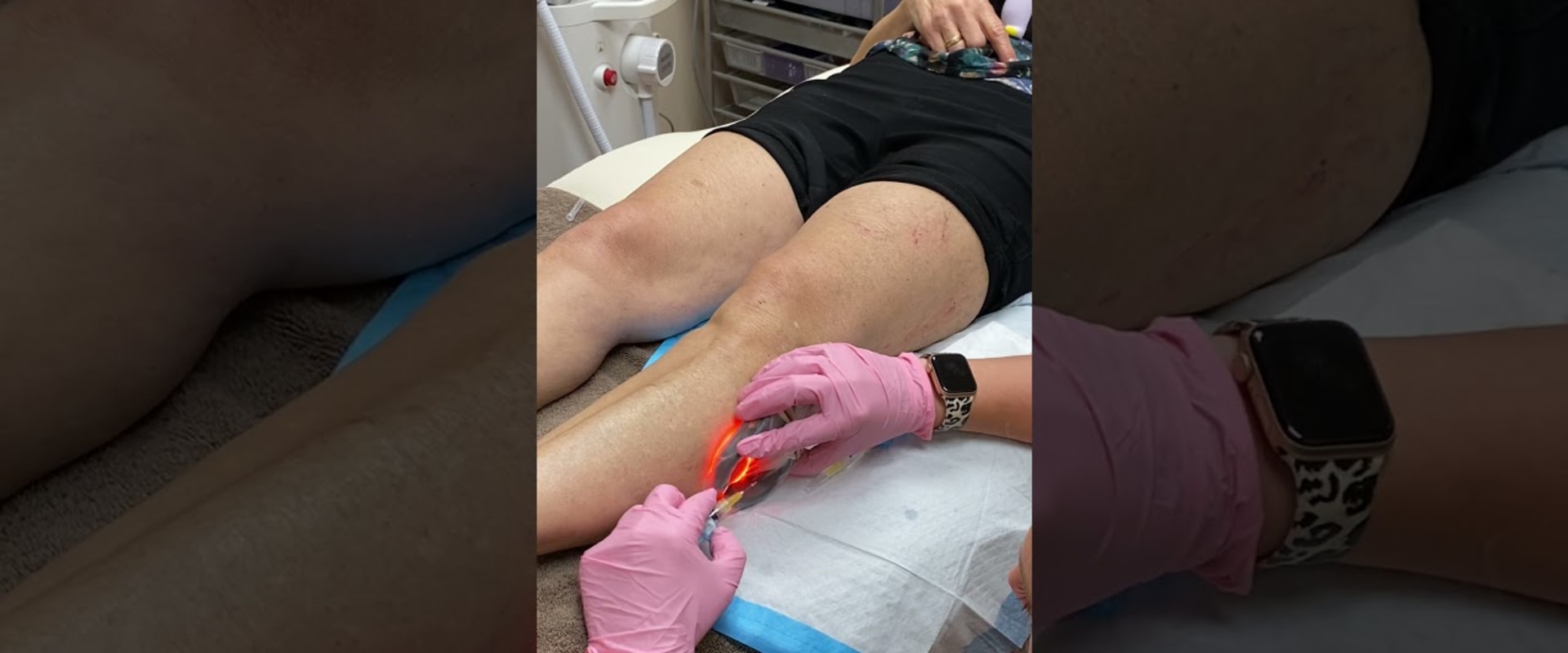 What is the Cost of Sclerotherapy for Treating Vein Diseases in St. Louis, Missouri?