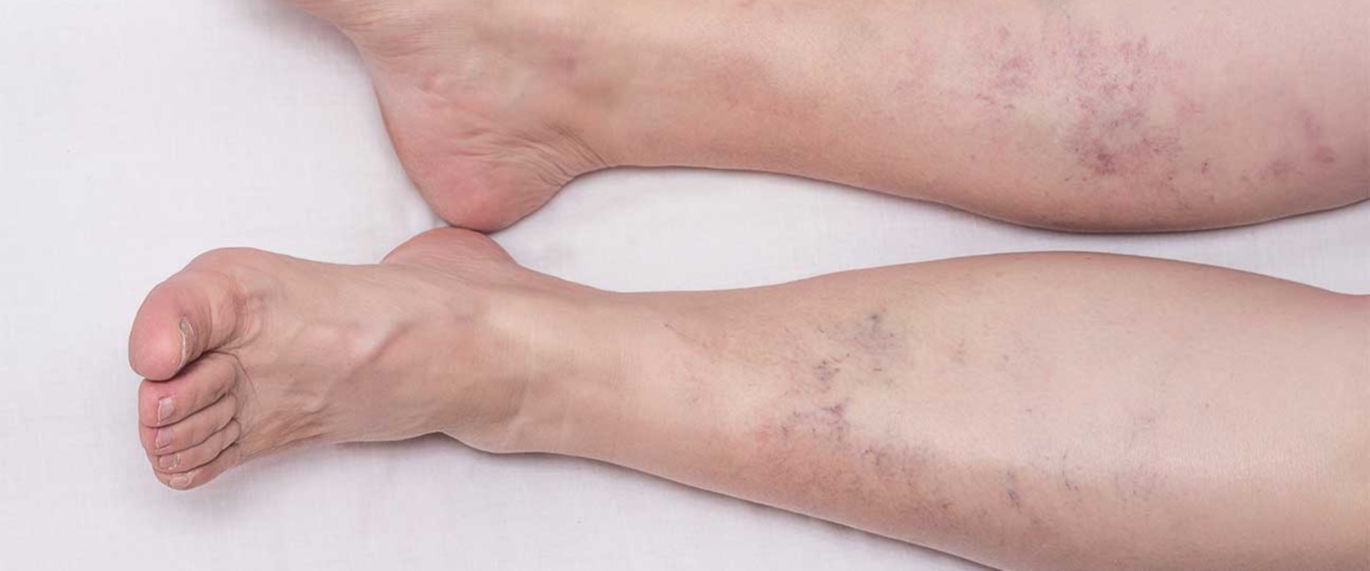 Understanding the Risks of Vein Disease Treatments in St. Louis, Missouri